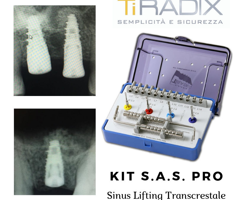 Sollevare il seno mascellare: oggi è semplice come mettere un impianto