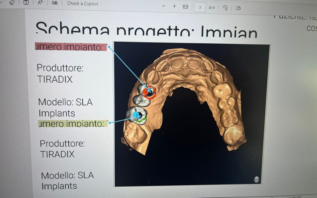 Riabilitazione a Carico Immediato mediante Chirurgia Guidata TiRADIX