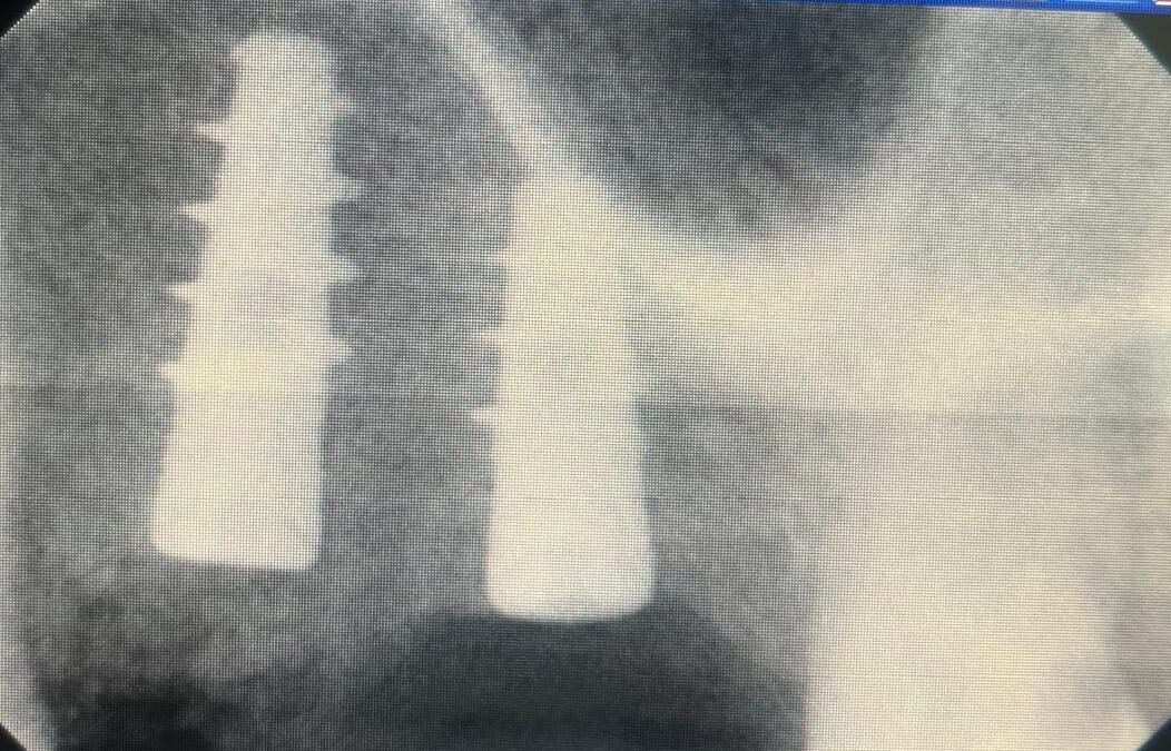 Riabilitazione in posizione 25 e 26 con GBR