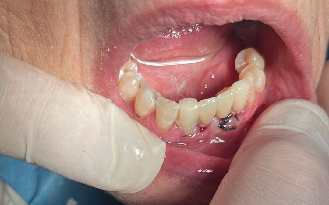 Riabilitazione post-estrattiva flapless a carico immediato in paziente anziana